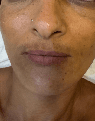 Lábios antes do preenchimento labial