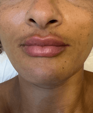 Lábios após preenchimento labial com resultado natural