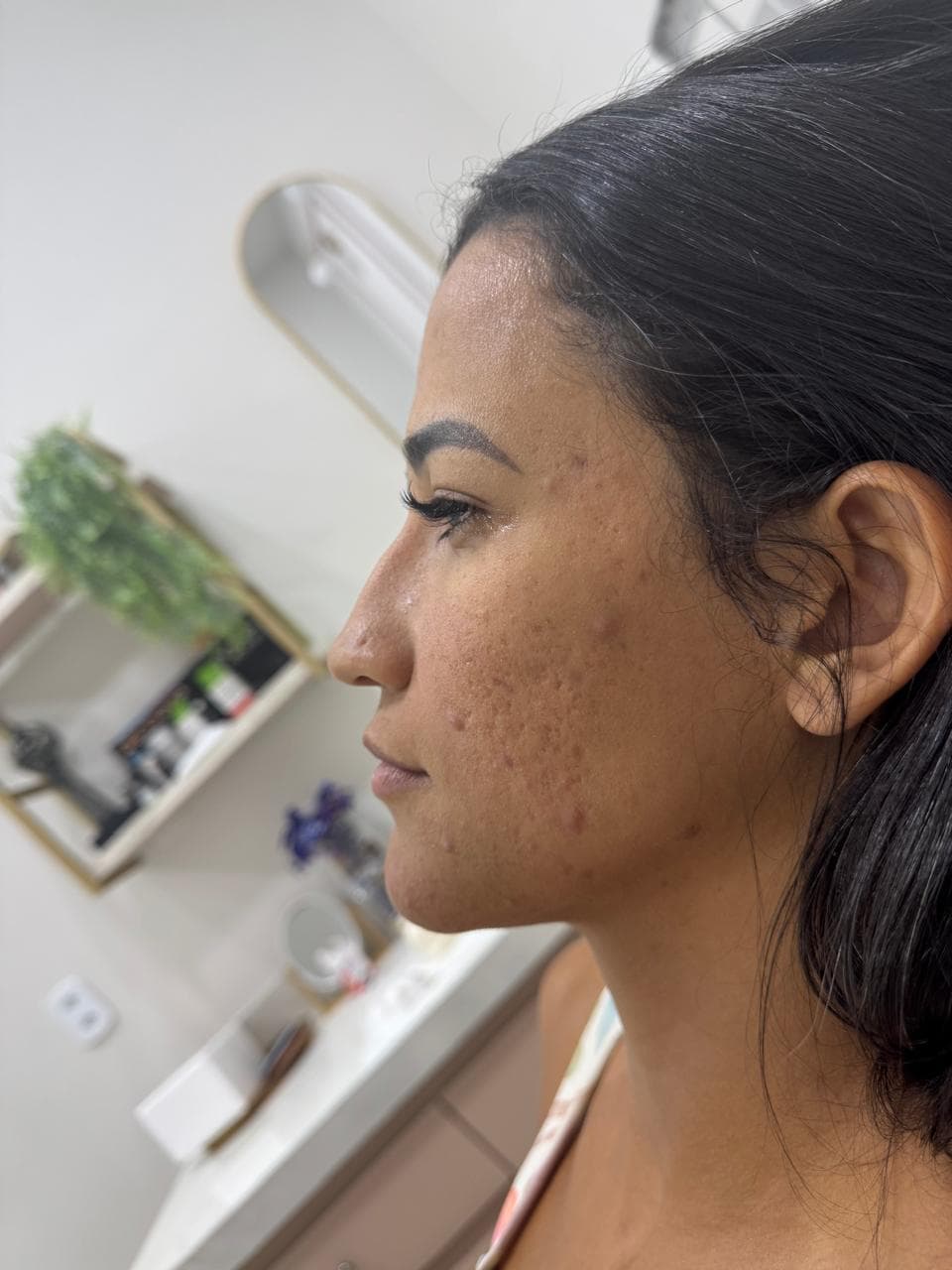 Perfil facial antes da perfiloplastia envolvendo nariz, lábio e mento
