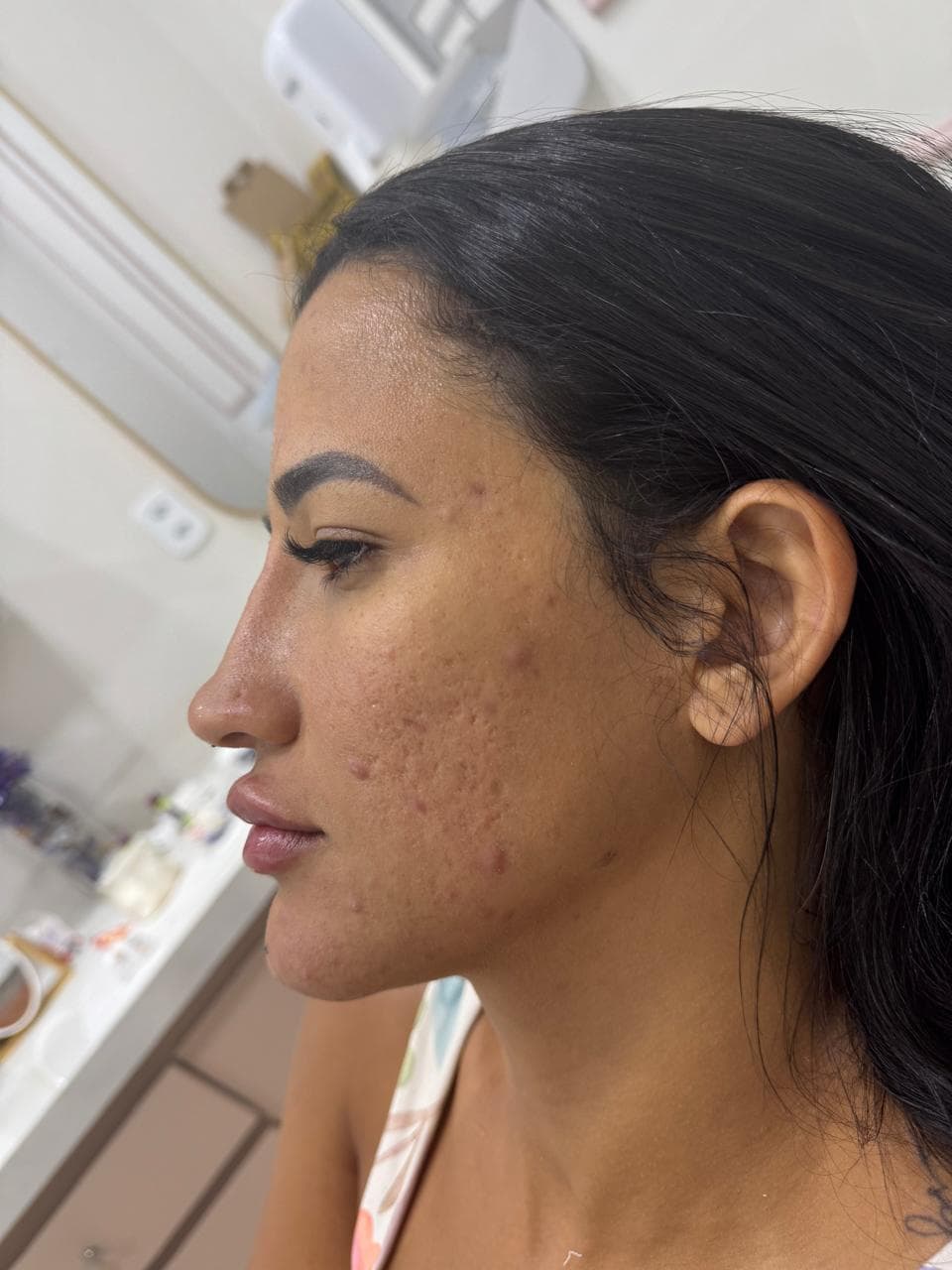 Perfil facial após perfiloplastia com resultado harmonioso